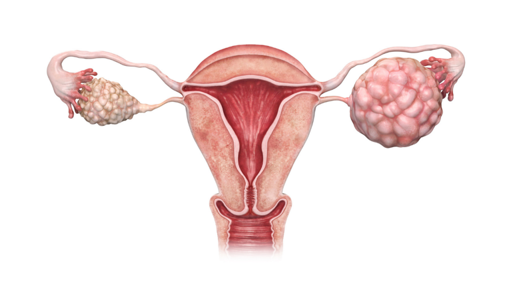Polycystic Ovarian Syndrome (PCOS): Diagnosis, Treatment, & Medication